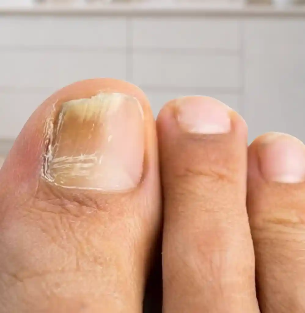 Close-up of a damaged and discolored big toenail that may be considered for nail restoration