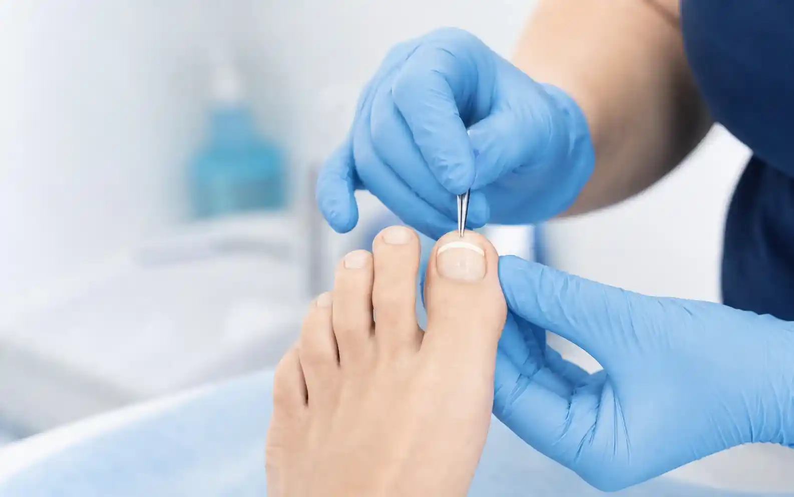 Podiatrist applying a thin white composite nail correction brace to a patient's big toenail